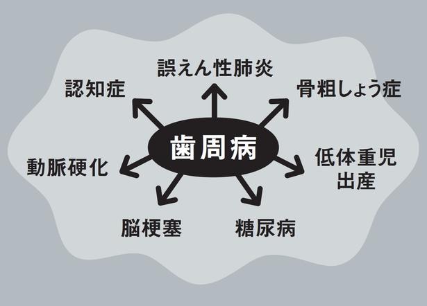 〝汚口〞を放っておくと歯周病から全身疾患に