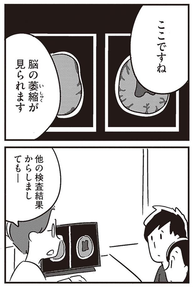 脳の萎縮が見られます （C）吉田いらこ／KADOKAWA