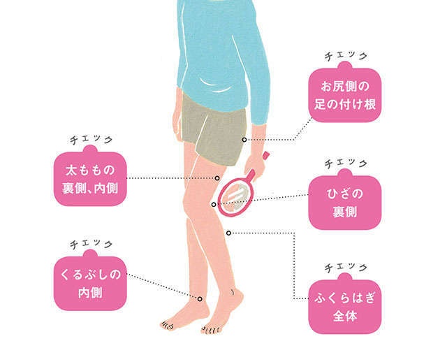 「下肢静脈瘤」をセルフチェック！ 血管が浮き出てる？ 赤く透けてる？ 治療の流れも詳しく解説（1）
