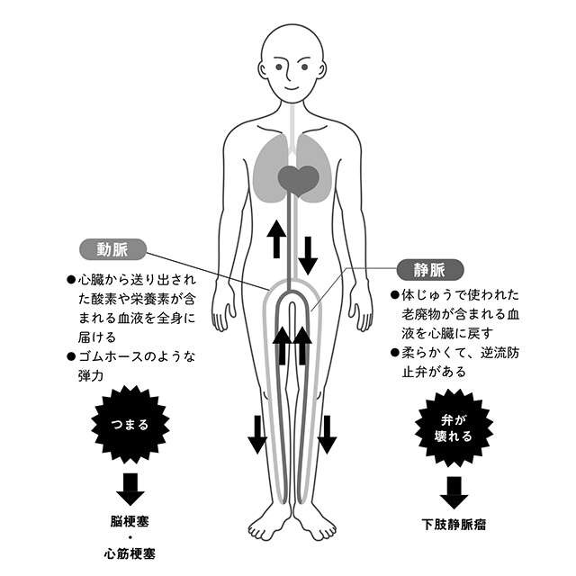 「下肢静脈瘤」はなぜ起こる？ 身体の仕組みを理解して「リスク」に備えよう（2）