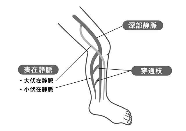 足がボコボコ...「だるさ」「むくみ」もある...もしかして「静脈」の病気かも（1）