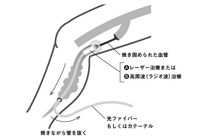 「下肢静脈瘤」の最新治療法！ 「血管内治療」の仕組みを医師が解説（1）