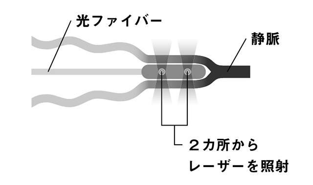 「下肢静脈瘤」の最新治療法！ 「血管内治療」の仕組みを医師が解説（3）