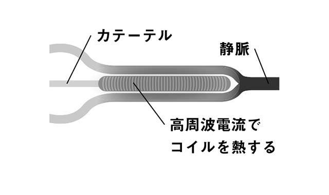 「下肢静脈瘤」の最新治療法！ 「血管内治療」の仕組みを医師が解説（4）