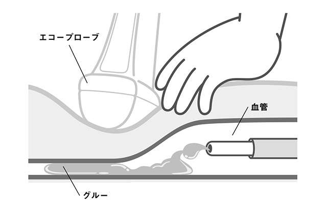 最新の「下肢静脈瘤」治療「グルー治療」って？ 仕組みやメリットを医師がまるっと解説（1）