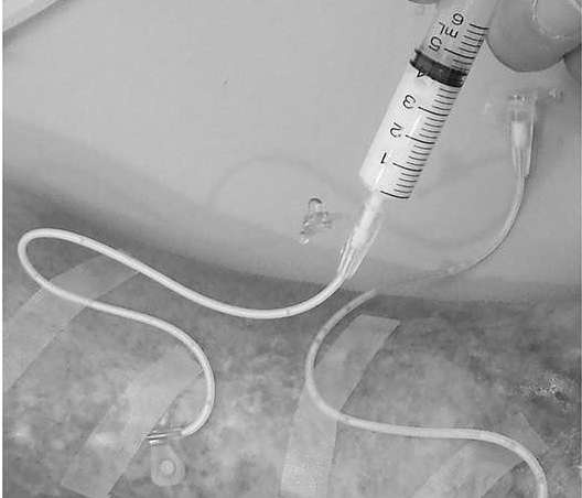 血管に薬剤注射する「硬化療法」とは？ 「下肢静脈瘤」の治療法を徹底解説（1）