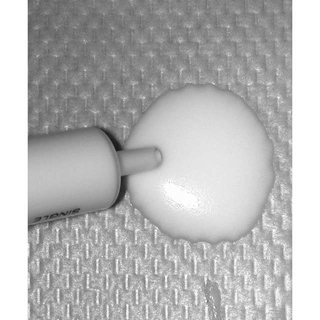 血管に薬剤注射する「硬化療法」とは？ 「下肢静脈瘤」の治療法を徹底解説（2）