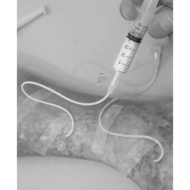 血管に薬剤注射する「硬化療法」とは？ 「下肢静脈瘤」の治療法を徹底解説（3）