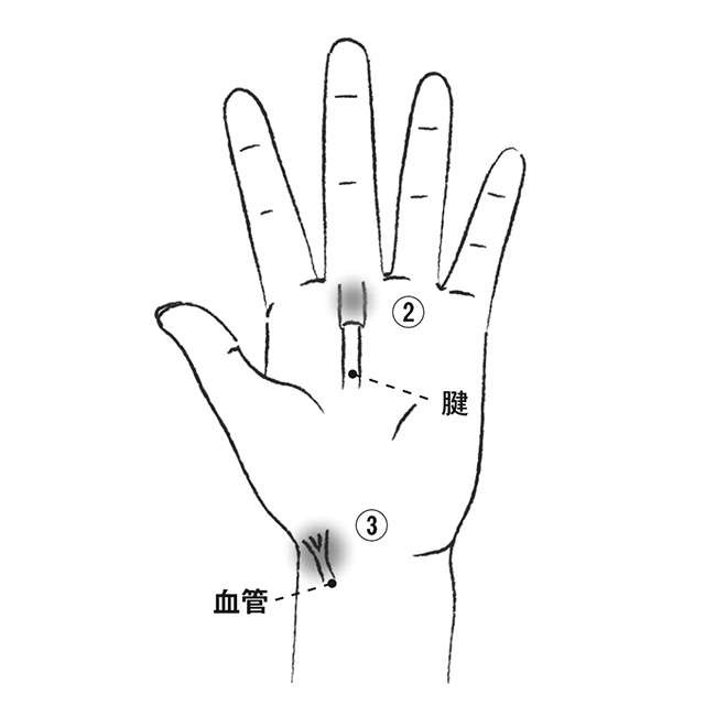 放置しても大丈夫？ どんなときに治療する？ 幅広い年齢層にできるしこり「ガングリオン」を解説（3）
