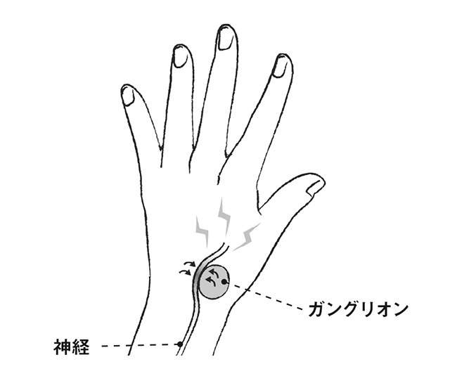 放置しても大丈夫？ どんなときに治療する？ 幅広い年齢層にできるしこり「ガングリオン」を解説（4）