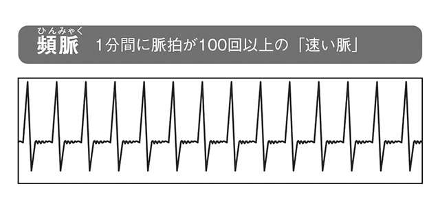 心筋梗塞や心不全の前兆となることも！ 命に関わる危険な「不整脈」の見分け方（4）