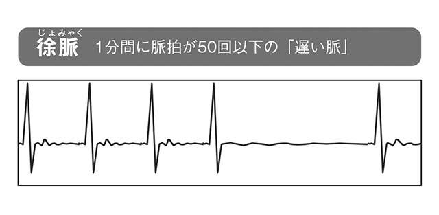 心筋梗塞や心不全の前兆となることも！ 命に関わる危険な「不整脈」の見分け方（5）