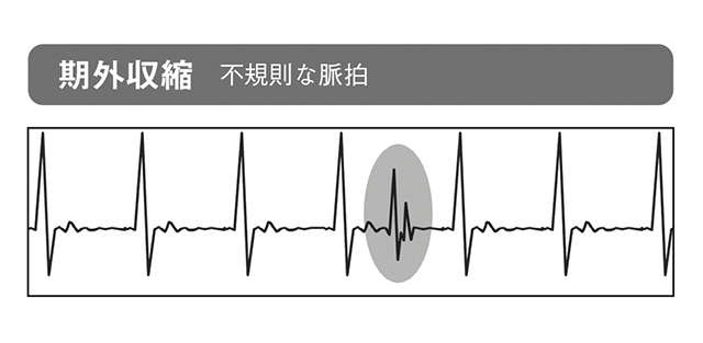 心筋梗塞や心不全の前兆となることも！ 命に関わる危険な「不整脈」の見分け方（6）