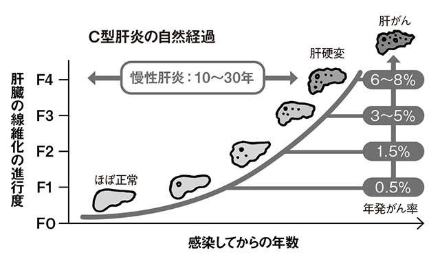 約30年で肝硬変、約40年で肝がんに進行する「C型肝炎」の画期的な新薬／NEWSなキーワード（2）