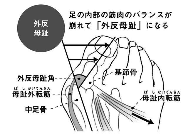 靴を履かなくても痛む場合も...「外反母趾」は早期セルフケアで悪化を食い止めて（4）