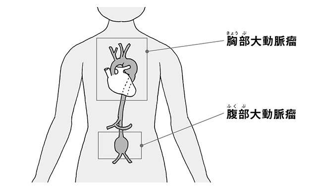 しゃがれた声が危険のサインかも。破裂したら死亡確率は8割！心臓の専門医による「大動脈瘤」を防ぐ方法（3）