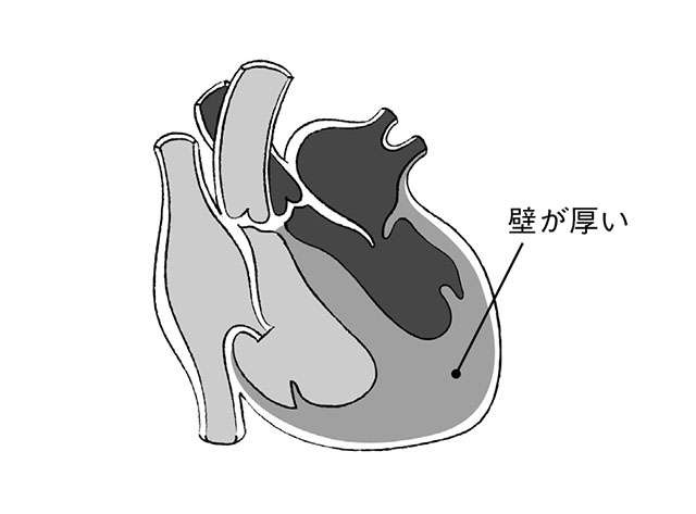 心不全の前段階「心肥大」は生活習慣で対策を！ 猪又教授に教わる「心臓にいいウォーキング」（3）