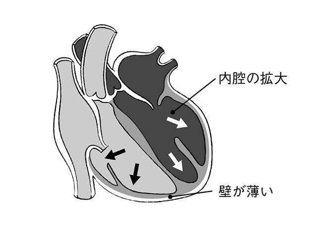 心不全の前段階「心肥大」は生活習慣で対策を！ 猪又教授に教わる「心臓にいいウォーキング」（4）