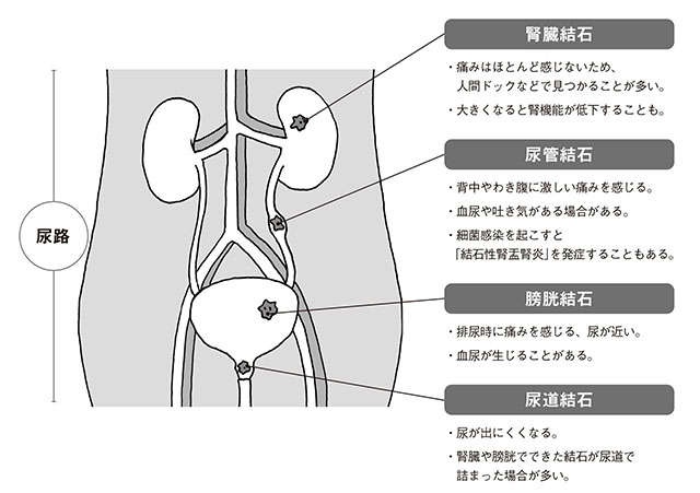 専門医が解説する「尿管結石」。男性は7人に1人、女性も中年以降は特に注意。原因が食習慣の可能性も（3）
