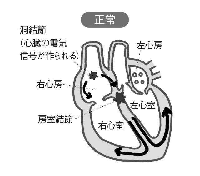 脳梗塞のリスクが約5倍になり、認知症にもつながる「心房細動」。妹尾恵太郎先生が解説（2）