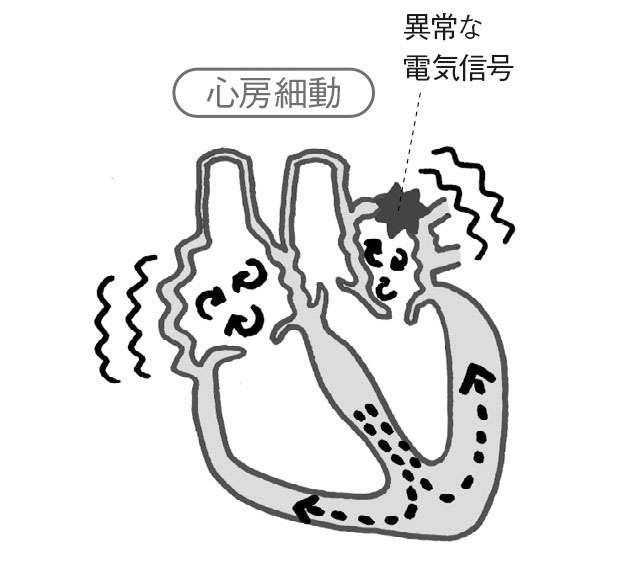脳梗塞のリスクが約5倍になり、認知症にもつながる「心房細動」。妹尾恵太郎先生が解説（3）