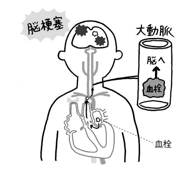 脳梗塞のリスクが約5倍になり、認知症にもつながる「心房細動」。妹尾恵太郎先生が解説（4）