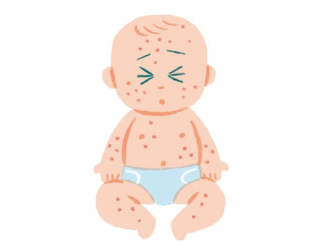 ほとんどの子の「病気デビュー」はコレ！小児科医が教える「突発性発疹」の症状とおうちケア（2）