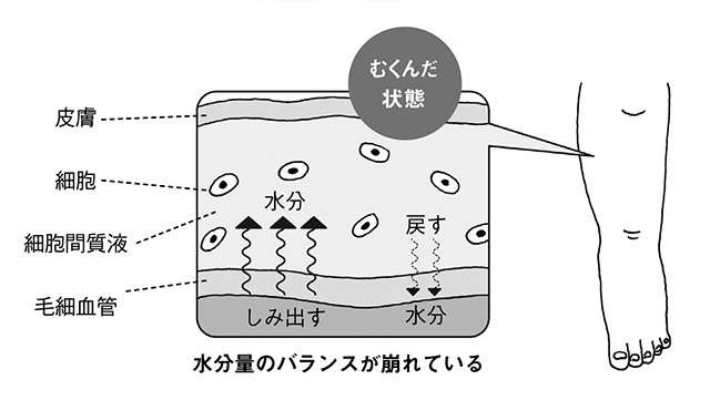 心臓血管外科医の藤井先生が指南！「危険なむくみ」は原因を知って早めに治療を（4）
