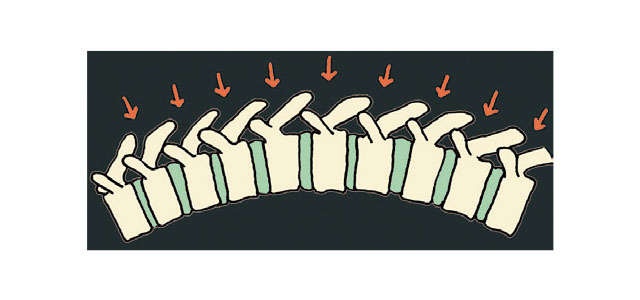 つらい腰痛に。脊柱管狭窄症は「寝たまま体操」で反り腰を改善【徳島大学医学部の西良浩一教授が伝授】（7）