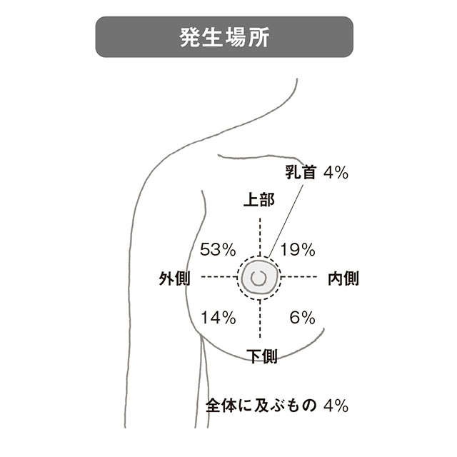 専門医の大野真司先生が警鐘「乳がんはゼロ期なら5年生存率はほぼ100％、だから乳がん検診を」（3）