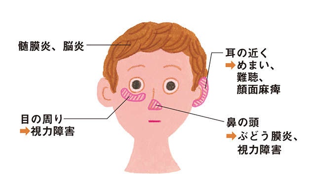 水ぼうそうのウイルスが数十年後に暴れだす？ 専門医の本田まりこ先生に「帯状疱疹」について聞きました（7）