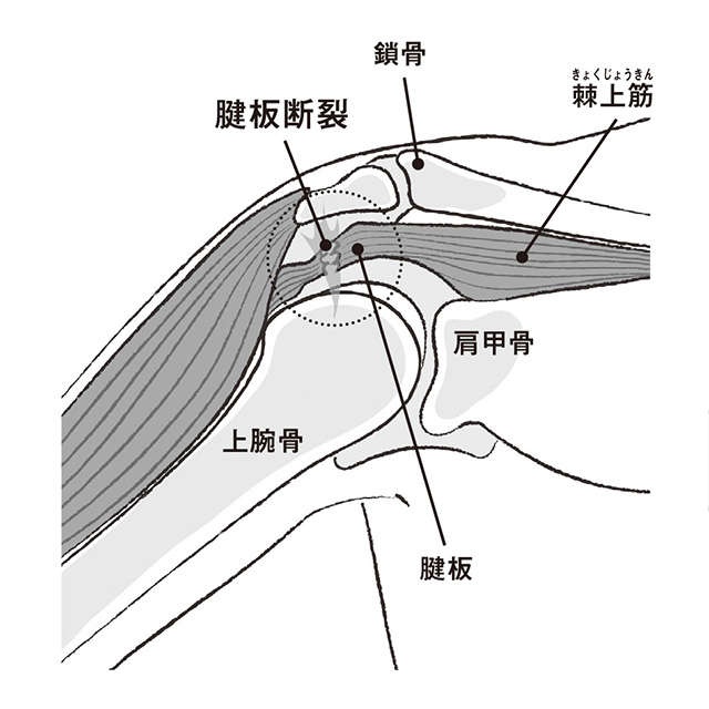 50歳以上の4人に1人が発症！ 五十肩と間違えやすい「肩の腱板断裂」【専門医・森原先生が解説】（3）
