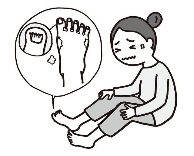 日本人の10人に1人は感染！ 爪水虫のセルフチェックと治療方法【専門医の常深祐一郎先生が解説】（2）