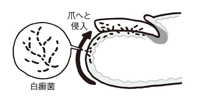 日本人の10人に1人は感染！ 爪水虫のセルフチェックと治療方法【専門医の常深祐一郎先生が解説】（3）