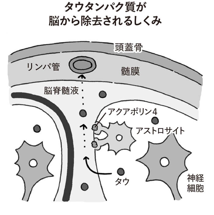 歯周病、睡眠不足、カビが、認知症を引き寄せる？ 【認知症予防の新常識】（3）