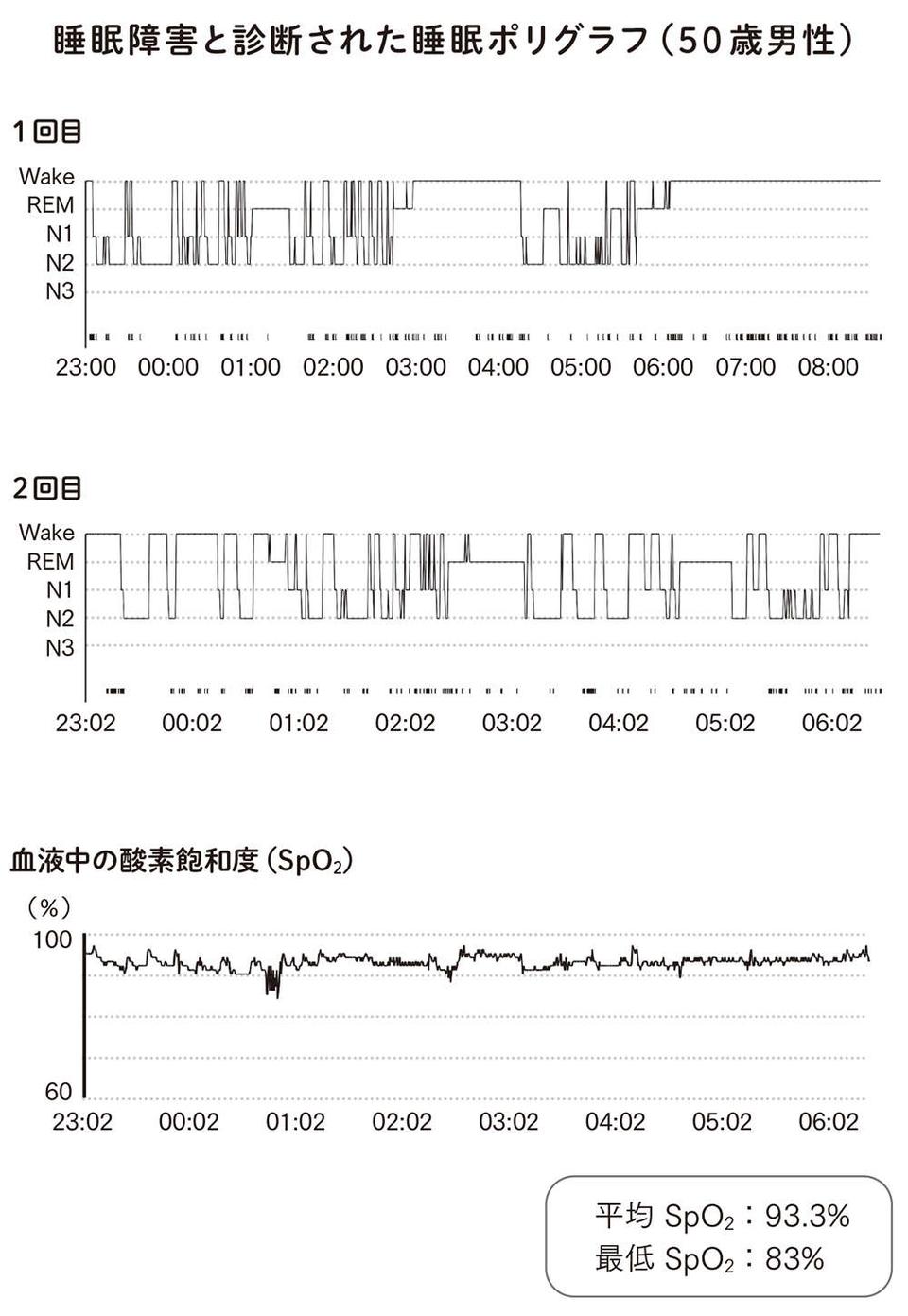 中高年になるとぐっすり眠れないのはなぜ？ 危ない睡眠と良い睡眠の違いを、脳内科医が解説（3）