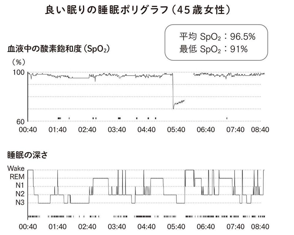 中高年になるとぐっすり眠れないのはなぜ？ 危ない睡眠と良い睡眠の違いを、脳内科医が解説（4）