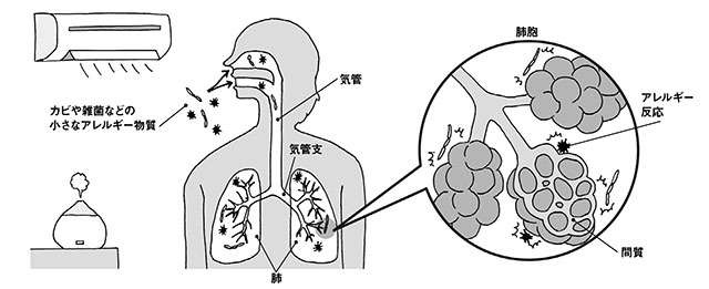 過敏性肺炎のリスクあり。 加湿器の雑菌やクーラーなどのカビに注意【呼吸器内科の坂本先生が解説】（3）