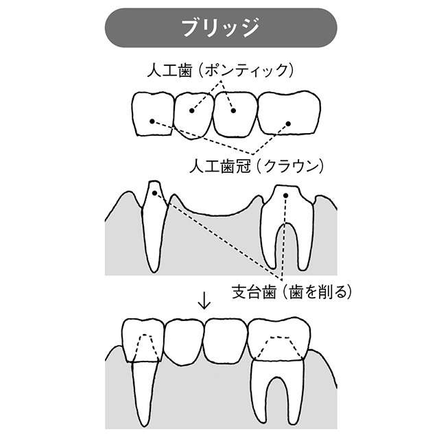 失った歯の代わりはどうする？ 自分にあった義歯の選び方【和田淳一郎先生が解説】（3）
