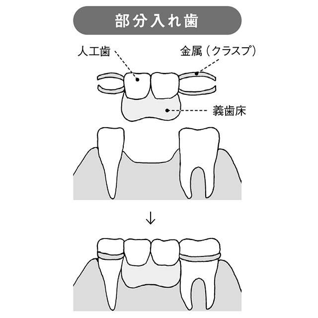 失った歯の代わりはどうする？ 自分にあった義歯の選び方【和田淳一郎先生が解説】（4）