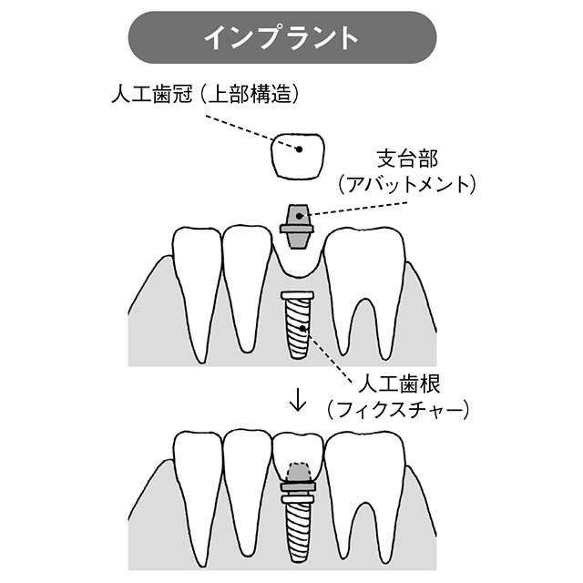 失った歯の代わりはどうする？ 自分にあった義歯の選び方【和田淳一郎先生が解説】（5）