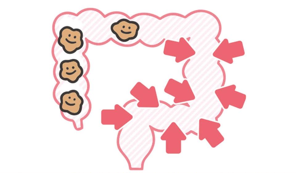 出したのにお腹が張るのは、おしりの「出口」で事件が発生!? 「出口の便秘」とは【チェックシート付】（3）