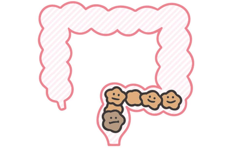 出したのにお腹が張るのは、おしりの「出口」で事件が発生!? 「出口の便秘」とは【チェックシート付】（5）