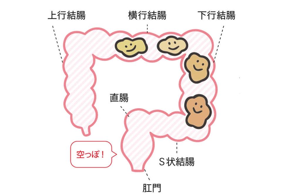 出したのにお腹が張るのは、おしりの「出口」で事件が発生!? 「出口の便秘」とは【チェックシート付】（6）