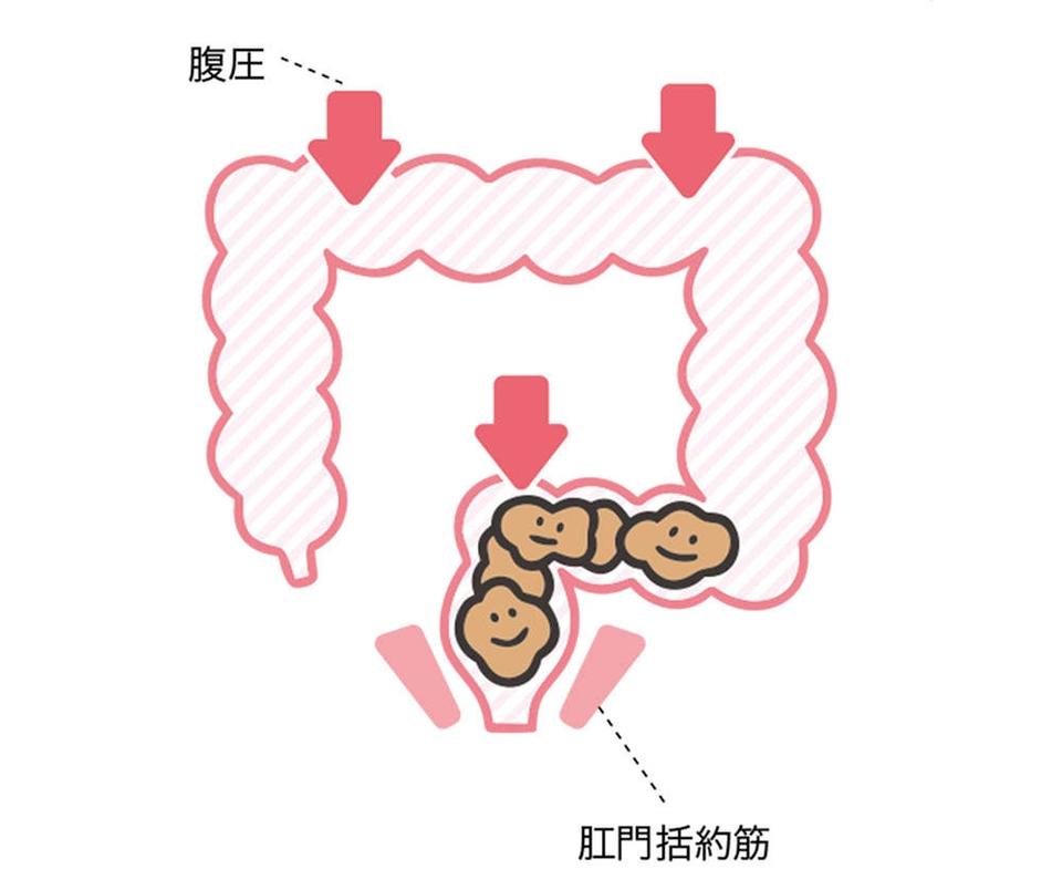 出したのにお腹が張るのは、おしりの「出口」で事件が発生!? 「出口の便秘」とは【チェックシート付】（8）