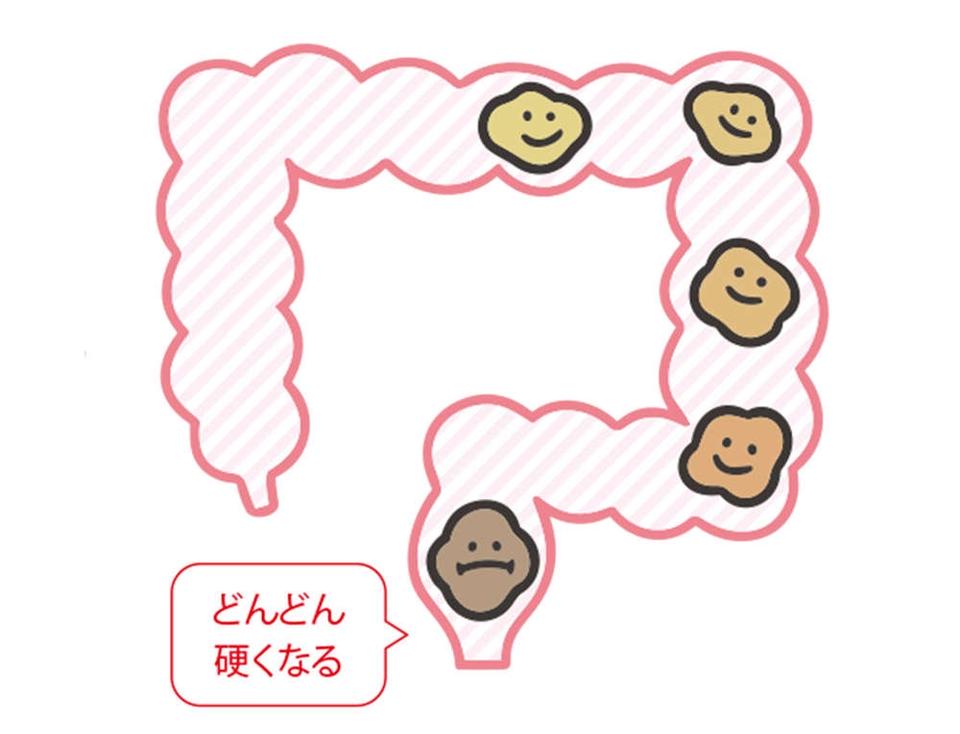 出したのにお腹が張るのは、おしりの「出口」で事件が発生!? 「出口の便秘」とは【チェックシート付】（11）