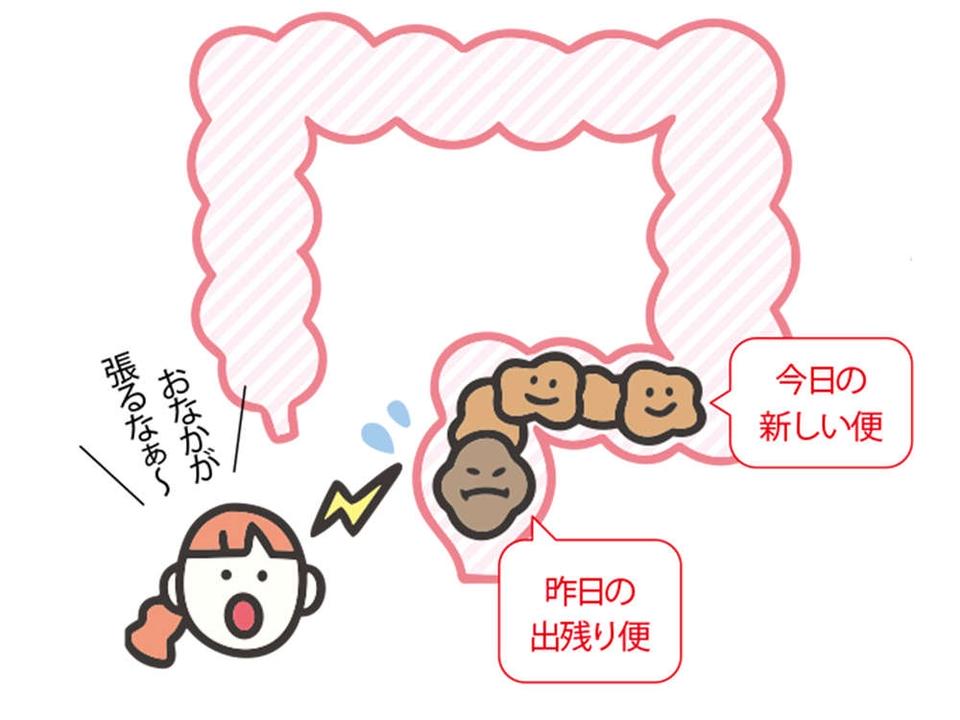 出したのにお腹が張るのは、おしりの「出口」で事件が発生!? 「出口の便秘」とは【チェックシート付】（12）