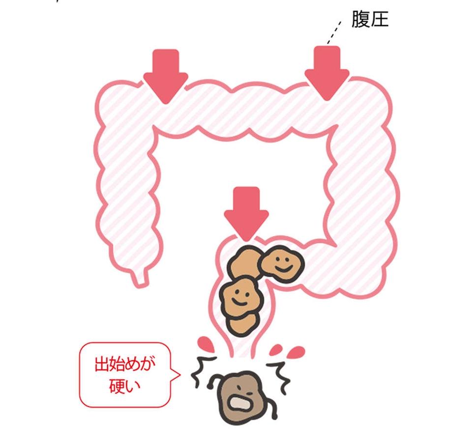 出したのにお腹が張るのは、おしりの「出口」で事件が発生!? 「出口の便秘」とは【チェックシート付】（13）