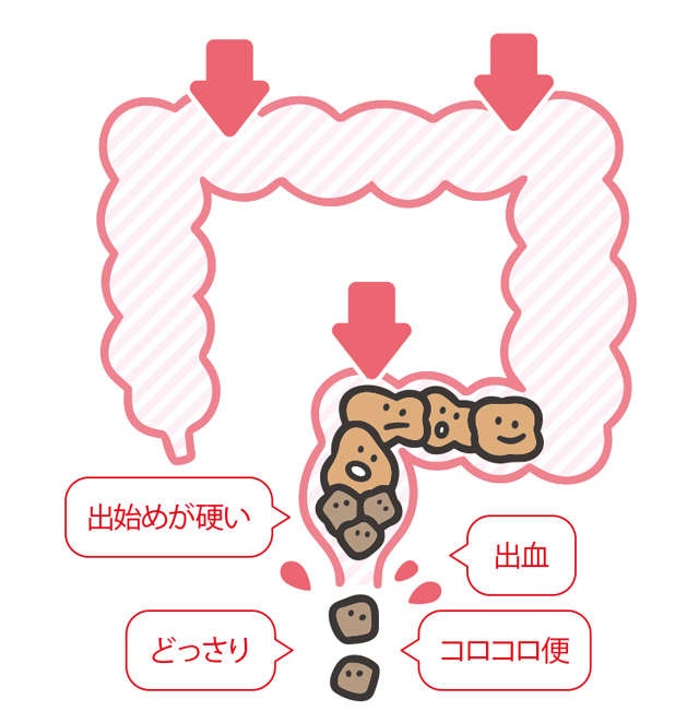 毎日便が出るからと言って「全部出ている」わけじゃない？ 勘違いしがちな「便秘」の定義（5）
