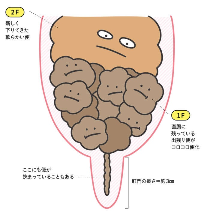 毎日便が出るからと言って「全部出ている」わけじゃない？ 勘違いしがちな「便秘」の定義（7）